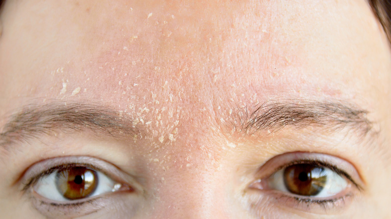 Forehead of a woman with flaky skin
