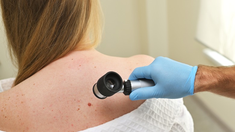 Dermatologist examining mole on woman's back