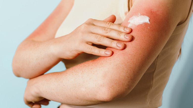 Person applying after-sun lotion to sunburned skin on arm