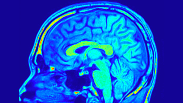 MRI of human brain