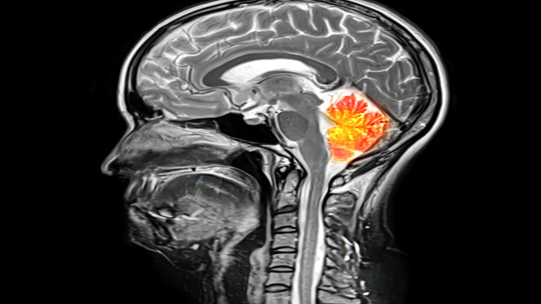 Composite image of MRI scan of the brain with cerebellum highlighted