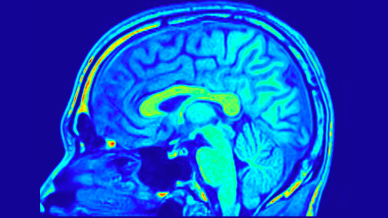 Scan image of the brain