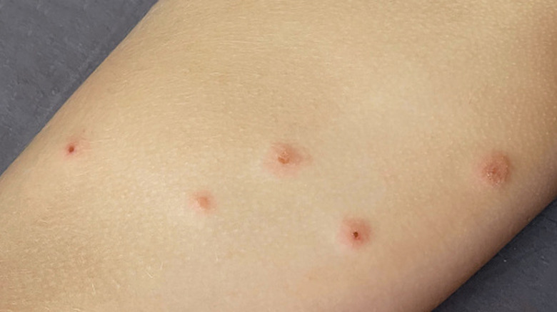 A line of bed bug bites on a human