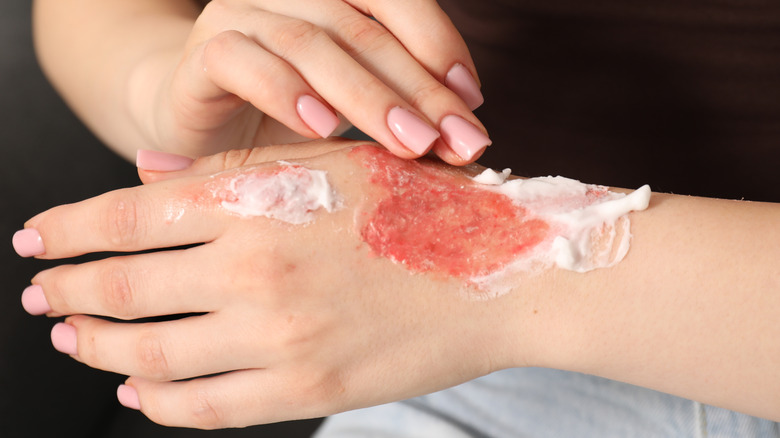 Woman spreading cream on a burn wound