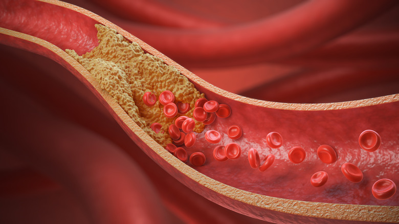 A 3-D illustration of cholesterol plaque buildup in a blood vessel.