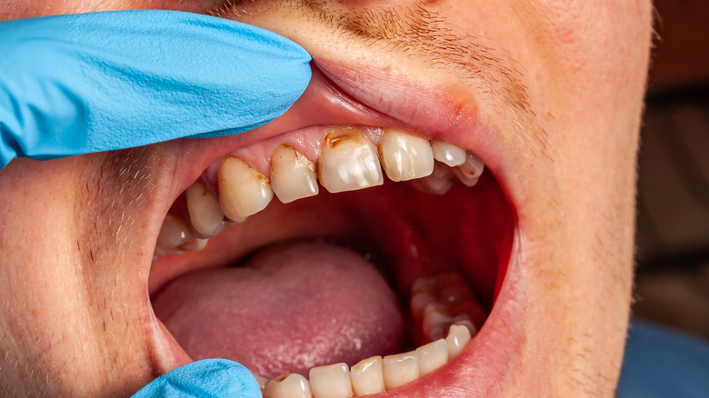 Person having teeth examined by dentist