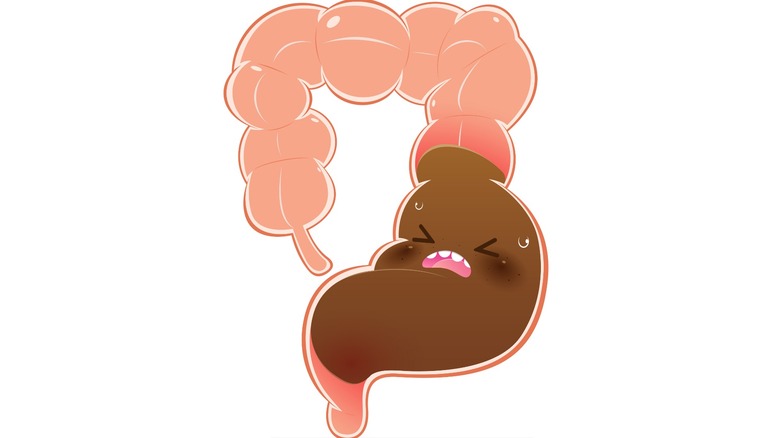 Illustration of the colon filled with a waste blockage