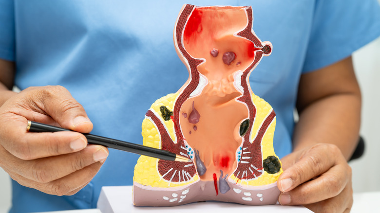 Doctor using a pen to point to an anatomical model of the rectum and canal leading to the anus