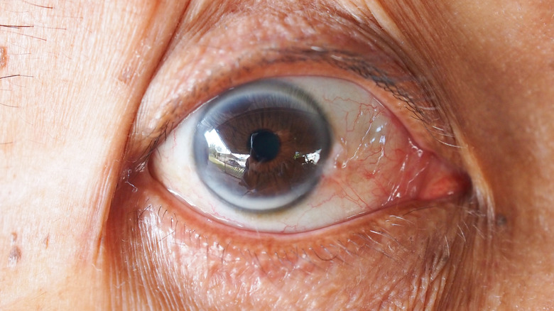 Arcus senilis impacting and older male