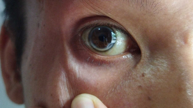 Close-up of an eye affected by arcus senilis