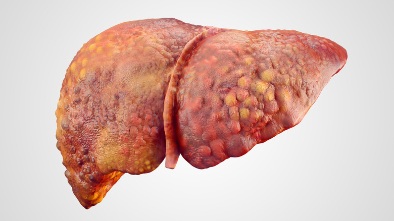 Model of an unhealthy liver