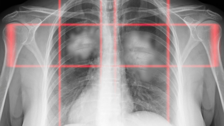 X-ray image showing cancer of the lungs