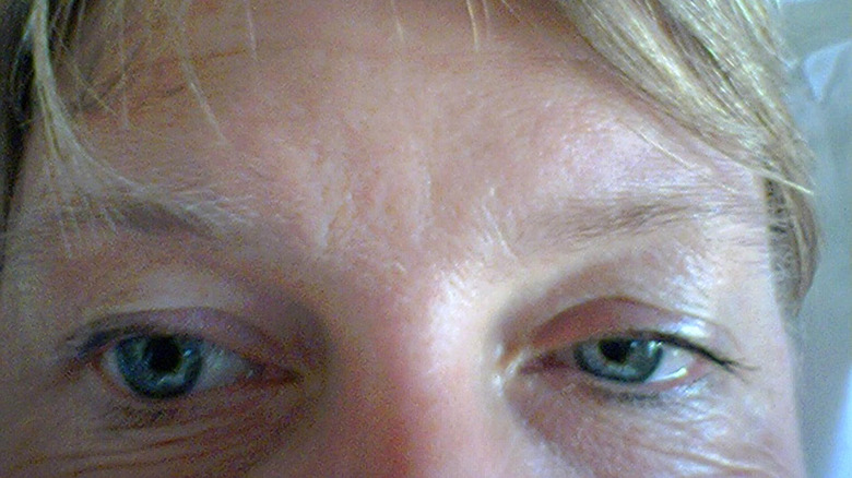close up of eyes with one side showing the characteristic droop and shrunk pupil