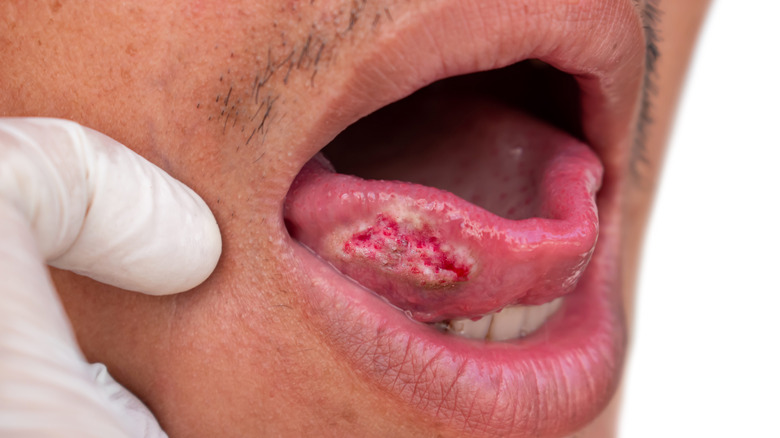 Squamous cell carcinoma on tongue