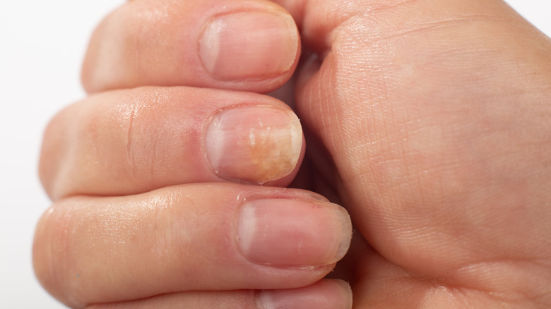 Close-up of yellowing fingernails