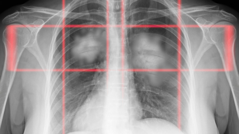 X-ray image showing cancer of the lungs