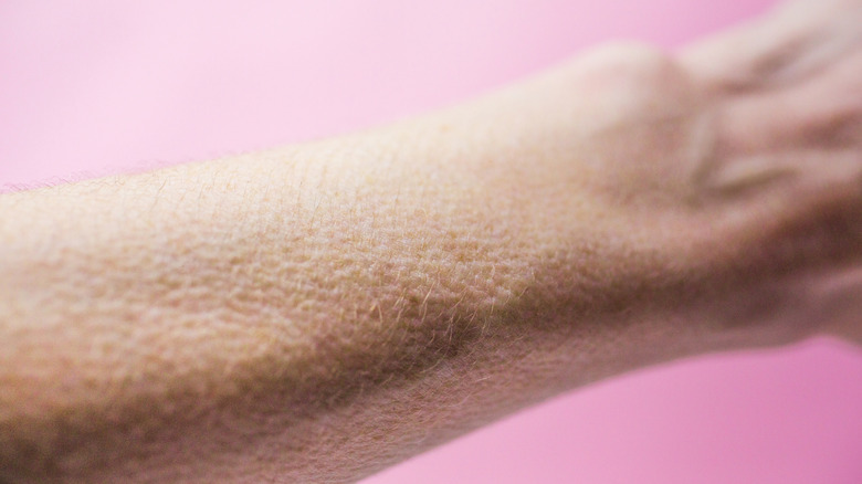 Goosebumps on a person's arm