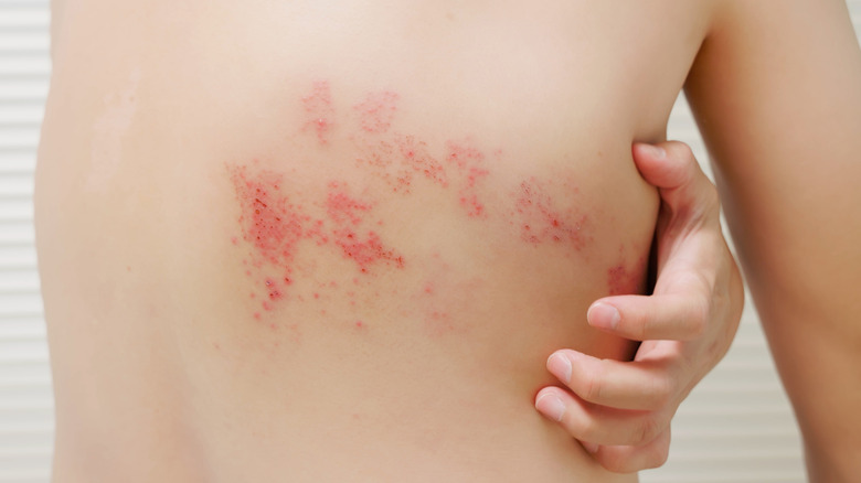 Person with painful shingles rash around trunk of body