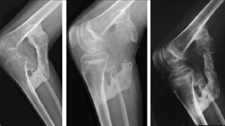 X-rays of a knee showing the connective tissue turning to bone in a patient with FOP