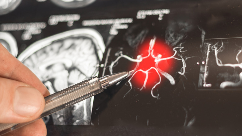 A doctor pointing to a brain scan