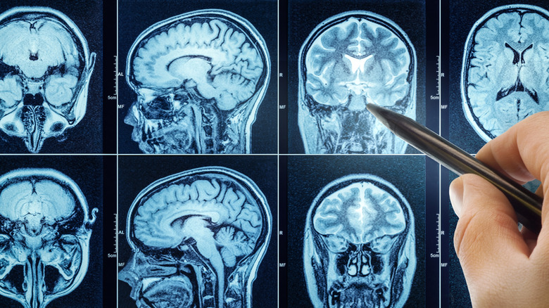 Doctor points to brain scan images with a pen