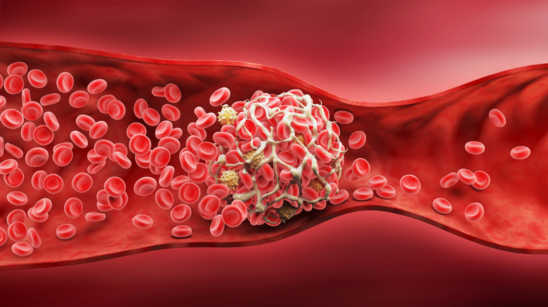 Illustration of a blood clot