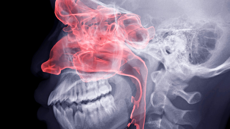 X-ray image of side of human head, sinuses highlighted in red