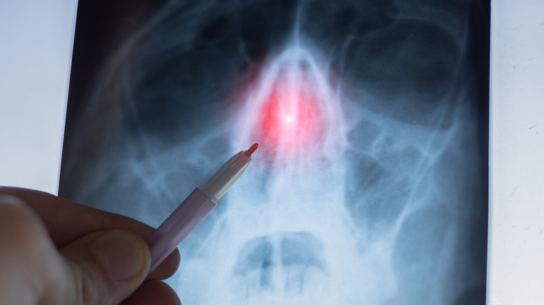 Hand holding stylus pointing at X-ray of face, nasal cavity highlighted in red