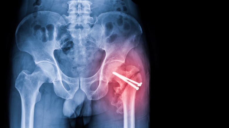 X-ray image of a hip fracture from osteoporosis