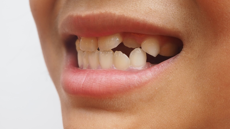 A young person with hyperdontia is opening their mouth