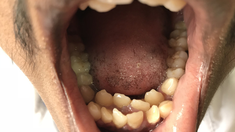 An example of hyperdontia