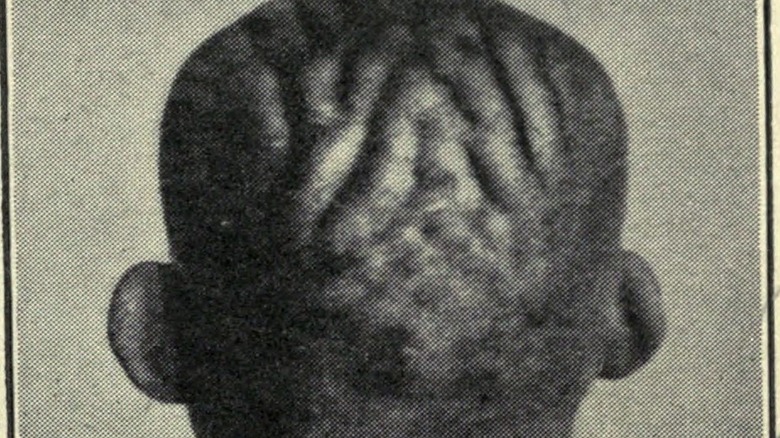A man with cutis verticis gyrata
