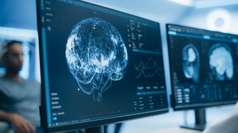 Brain scans on a computer screen