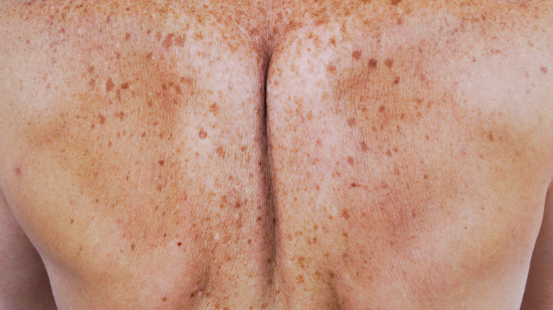 Image of a person's back with hyperpigmentation