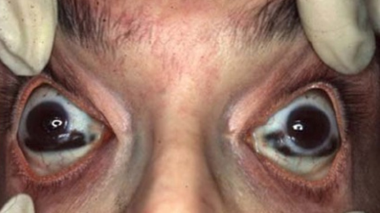Tache noire in eyes after death