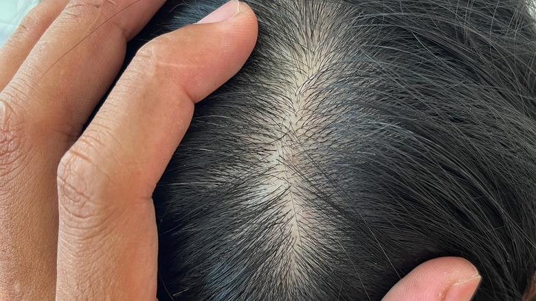 Close up of human scalp with hair follicles showing