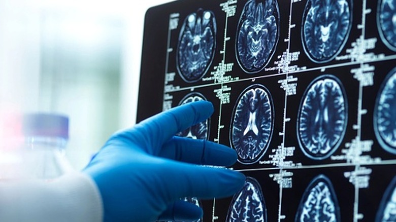 A doctor pointing at images of brain scans