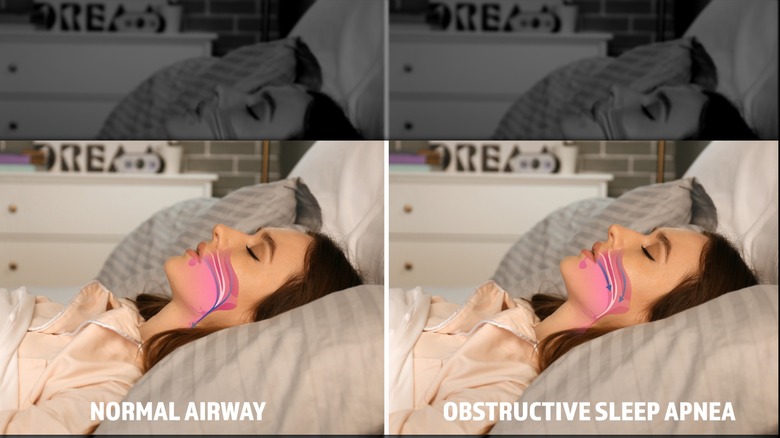 Images of young woman sleeping, showing the difference between normal snoring and sleep apnea
