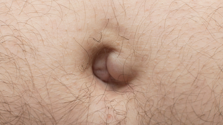 Belly button hernia in adult