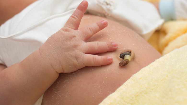 Umbilical stump on newborn baby