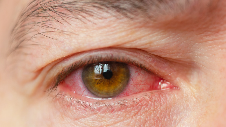 Close-up of human male eye with pink eye, red and inflamed