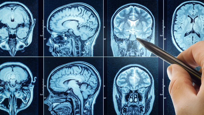 Hand holding a pen pointing to medical imagery of a brain