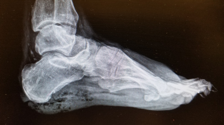 An X-ray of a foot with necrotizing fasciitis