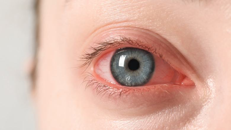 reddened irritated eye