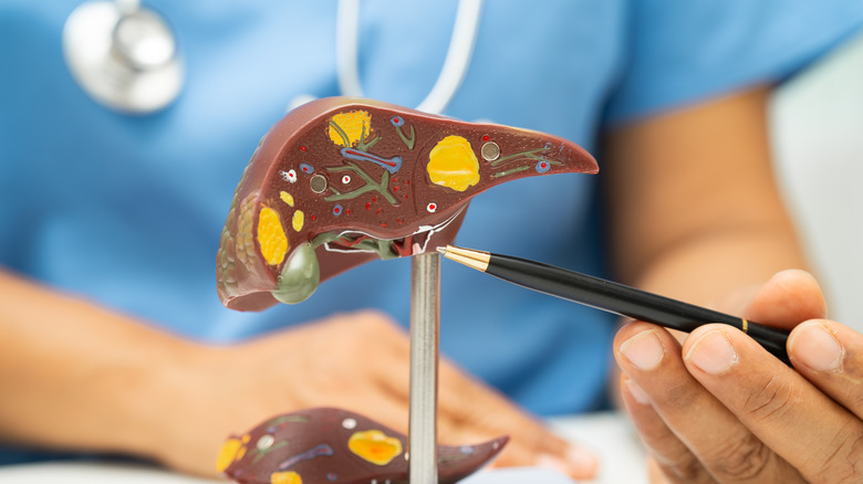 Liver anatomy model showing fat deposits in the liver