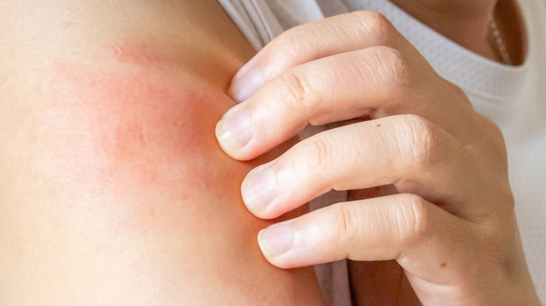 Hand scratching itchy, red skin