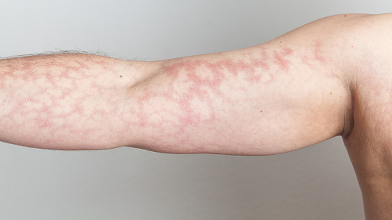 Outstretched arm with mottled skin pattern