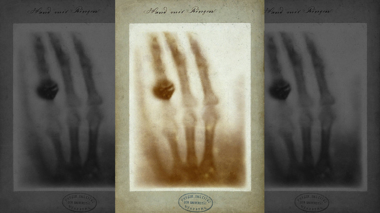 First ever X-ray of Wilhelm ﻿Röntgen's Anna Bertha Ludwig's hand