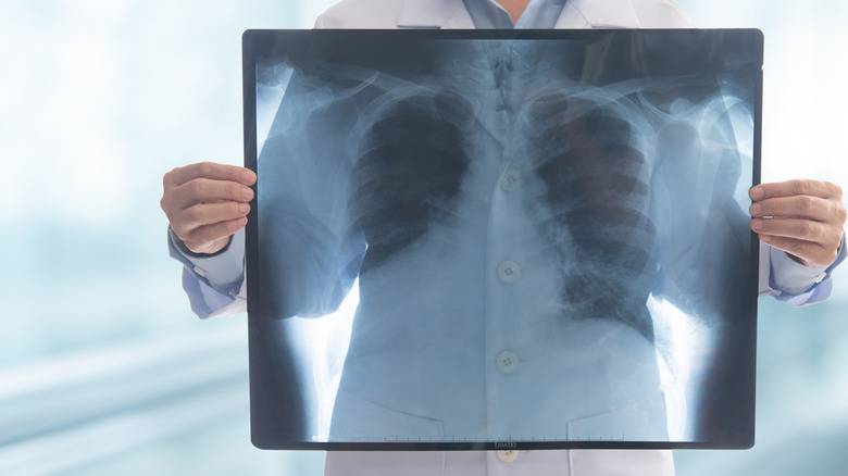 Doctor white coat holding up X-ray image in front of chest
