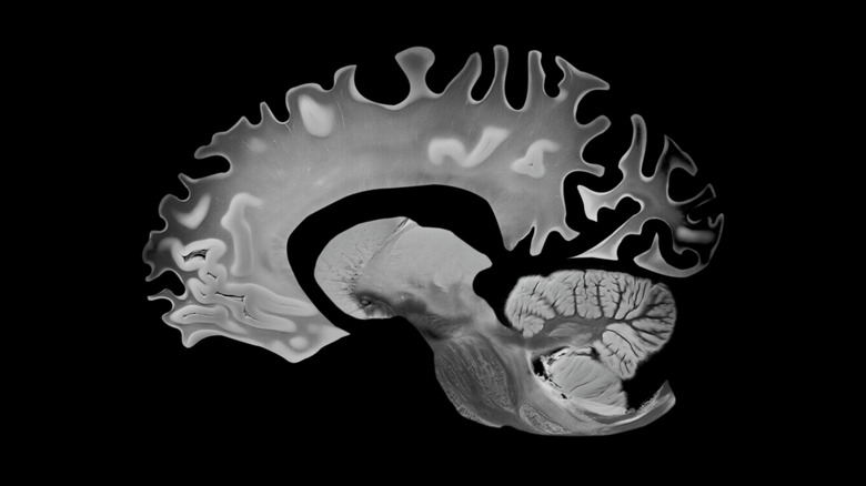 damage to the brain caused by Alzheimer's